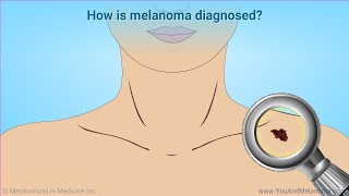 Diagnosing Melanoma [upl. by Sivla322]