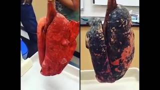 Smokers Lungs VS Nonsmokers Lungs [upl. by Erine884]