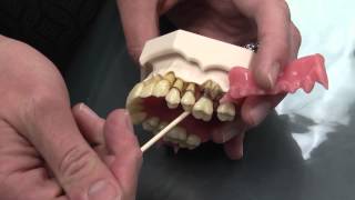 What is Periodontal Disease [upl. by Elram885]