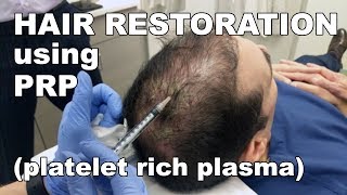 Scalp Hair Restoration using Platelet Rich Plasma  West End Plastic Surgery [upl. by Parks482]