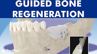 Guided bone regeneration  Bone graft © [upl. by Kantor]