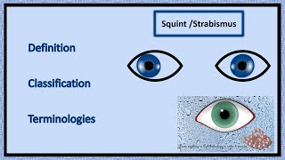 What Is Exotropia [upl. by Kelleher385]