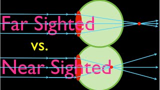 Farsighteness vs Nearsightedness An Explanation [upl. by Isabelle]