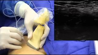 UltrasoundGuided Femoral Nerve Block [upl. by Aprilette]