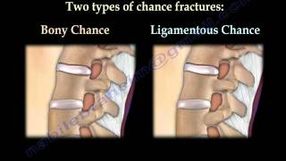 Chance Fractures of the Spine  Everything You Need To Know  Dr Nabil Ebraheim [upl. by Treb]