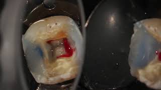 Complete endodontic treatment of a lower first molar step by step [upl. by Carita616]