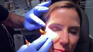 Demonstration Of Cannula Injection Of Cheek With Restylane Lyft [upl. by Glantz]