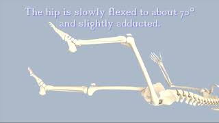 Hip Dislocation [upl. by Alpert]