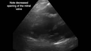 Left Ventricular Apical Thrombus [upl. by Imrots]