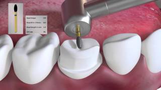 Crown preparation tutorial by Prof Brian Millar [upl. by Otilrac428]