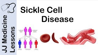 Sickle Cell Disease  Pathophysiology Symptoms and Treatment [upl. by Etneciv]