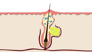 How Acne Develops  Acne Support [upl. by Kutzer697]