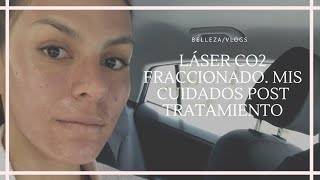 LASER CO2 FRACCIONADO POST TRATAMIENTO MI EXPERIENCIA [upl. by Leigh]