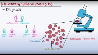 Hereditary Spherocytosis HS  Pathophysiology [upl. by Serafine191]