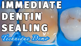 Biomimetic Dentistry Immediate Dentin Sealing with SelfEtch DBA [upl. by Ellemac]