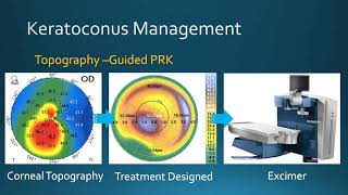 Keratoconus Management Corneal Crosslinking amp TopographyGuided PRK at Bochner Eye in Toronto [upl. by Daniell35]