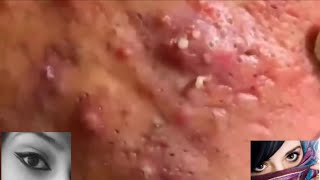 Severe Cystic Acne Infection Treatment Young Age [upl. by Bigner]