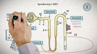 HIPONATREMIA Y SU TRATAMIENTO [upl. by Nylram]