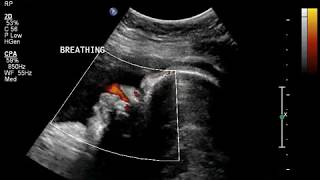 READING AND INTERPRETING A FETAL HEART RATE MONITOR [upl. by Aihsot29]