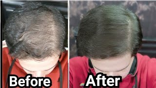 How to Use Rosemary Oil for Hair Growth Baldness Hair Loss Thinning Hair My Results w Pictures [upl. by Gnurt]