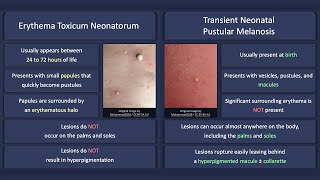 Erythema Toxicum Neonatorum vs Transient Neonatal Pustular Melanosis [upl. by Eniamrahc]