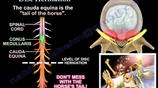 Disc Herniation  Everything You Need To Know  Dr Nabil Ebraheim [upl. by Aslin]