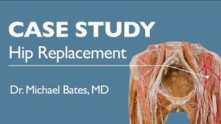 Hip Replacement Surgery Explained [upl. by Adnoel770]