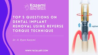 Dental Implant Removal Explantation Top Questions amp Answers [upl. by Kcarb]