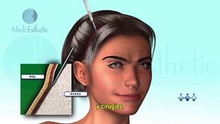 Laser fraccionado CO2 acne manchas y rejuvenecimiento  1 experiencia [upl. by Nitsruk]