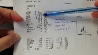 Hematology How to interpret automated Complete Blood Count CBC results [upl. by Heller189]