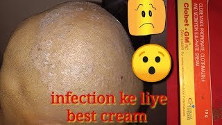 Clobet।GM।Clobetasol Propionate।Clotrimazole And Neomycin Sulphate Cream Review।Sonu Kumar Mishra। [upl. by Onig318]