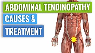 Abdominal Tendinopathy  Causes and Treatment Including Exercises [upl. by Skillern767]