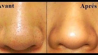 SUPPRIMER LES BOUTONS NOIR amp GRAISSE AU NEZ en 2 min Remove BLACKHEADS in just 2 min [upl. by Ahsineb]