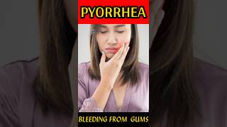 Pyorrhea Treatment At Home  Periodontitis Treatment  pyorrhea symptoms  BY Dr Sanjay Sundriyal [upl. by Lenej]