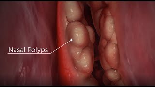 Nasal Packing for Severe Nosebleeds [upl. by Hameean361]