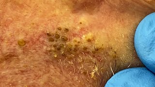 Extremely Clogged Pores Extracted  Contour Dermatology [upl. by Kloman]