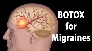 BOTOX for Migraines Animation [upl. by Dasha]