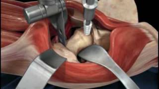 Direct Anterior Approach Hip Replacement [upl. by Anelrahs]