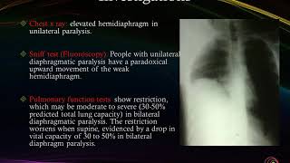 Diaphragmatic paralysis [upl. by Ykvir]