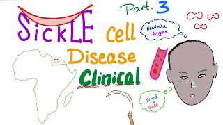 Sickle Cell Disease “part 3” Clinical Picture [upl. by Ihsoyim774]