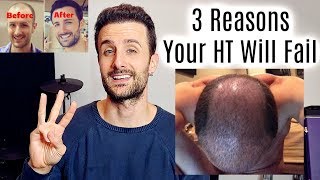 3 Reasons Your Hair Transplant Will FAIL [upl. by Atir162]