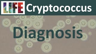 Diagnosing cryptococcal meningitis [upl. by Mari]