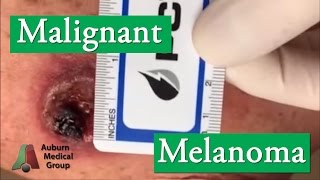 What Does Melanoma Look Like  Skin Cancer [upl. by Mighell]