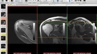 Systematic Interpretation of Shoulder MRI How I do it [upl. by Suoiluj461]