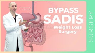 Gastric bypass surgery the procedure [upl. by Wilder]