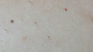 Acne Treatment on the Back Uninfected Lesions [upl. by Reynolds]