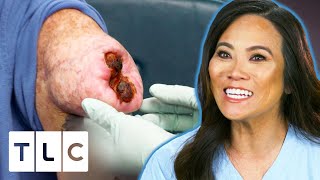 Dr Lee Removes An Open Wounded Lipoma  Dr Pimple Popper Pop Ups [upl. by Allissa724]