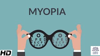 Myopia Signs and Symptoms Causes Diagnosis and Treatment [upl. by Hnim901]