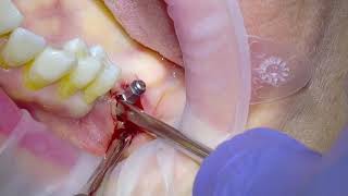 Removal of an infected Dental Implant [upl. by Karalee]