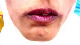 Orofacial Dyskinesia [upl. by Nadnerb106]